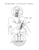 AUTOMATIC INJECTION DEVICE diagram and image