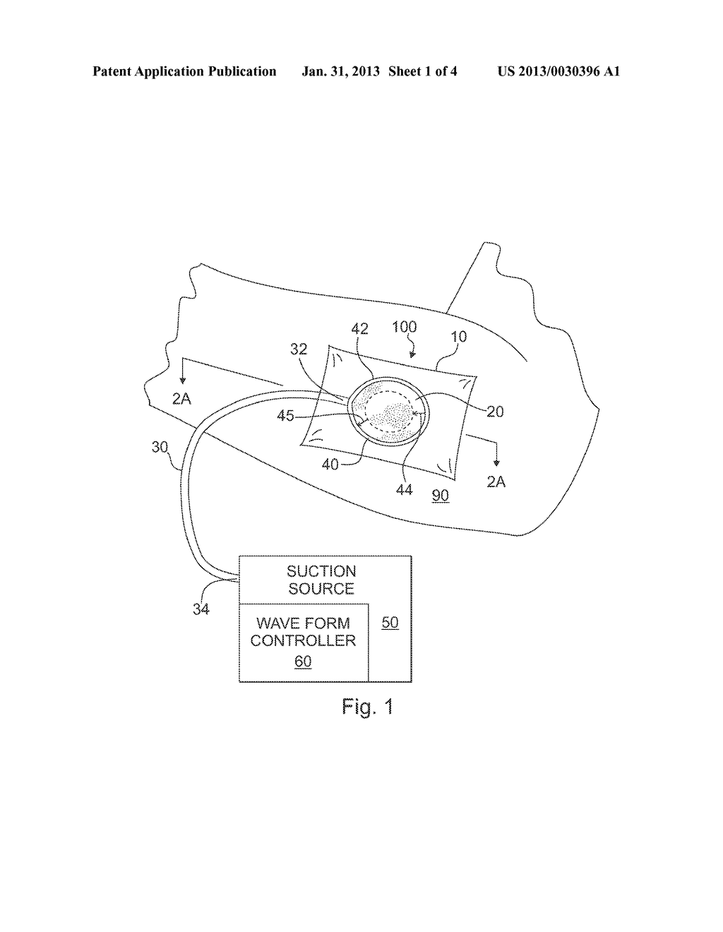 APPARATUS AND METHOD FOR WOUND TREATMENT EMPLOYING PERIODIC     SUB-ATMOSPHERIC PRESSURE - diagram, schematic, and image 02