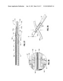 Single Action Tissue Sealer diagram and image