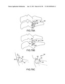 VERTEBRAL JOINT IMPLANTS AND DELIVERY TOOLS diagram and image