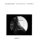 TIBIOTALAR ARTHRODESIS GUIDE diagram and image
