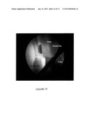 TIBIOTALAR ARTHRODESIS GUIDE diagram and image