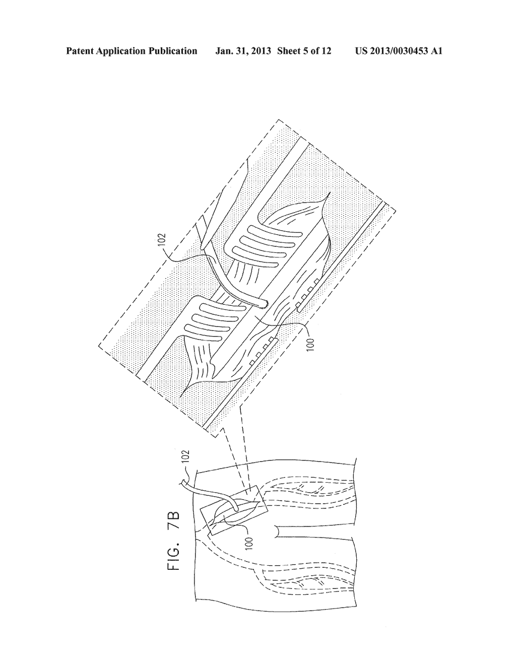 ADHESIVE PATCH VASCULAR APPLICATOR - diagram, schematic, and image 06