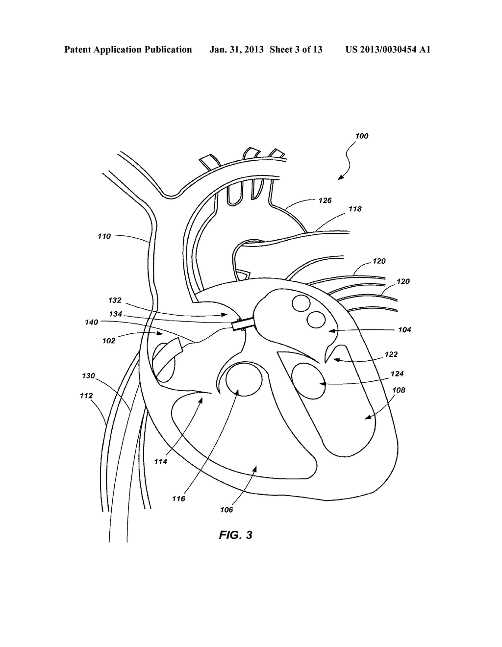 VENTRICULAR ASSIST DEVICE AND RELATED METHODS - diagram, schematic, and image 04