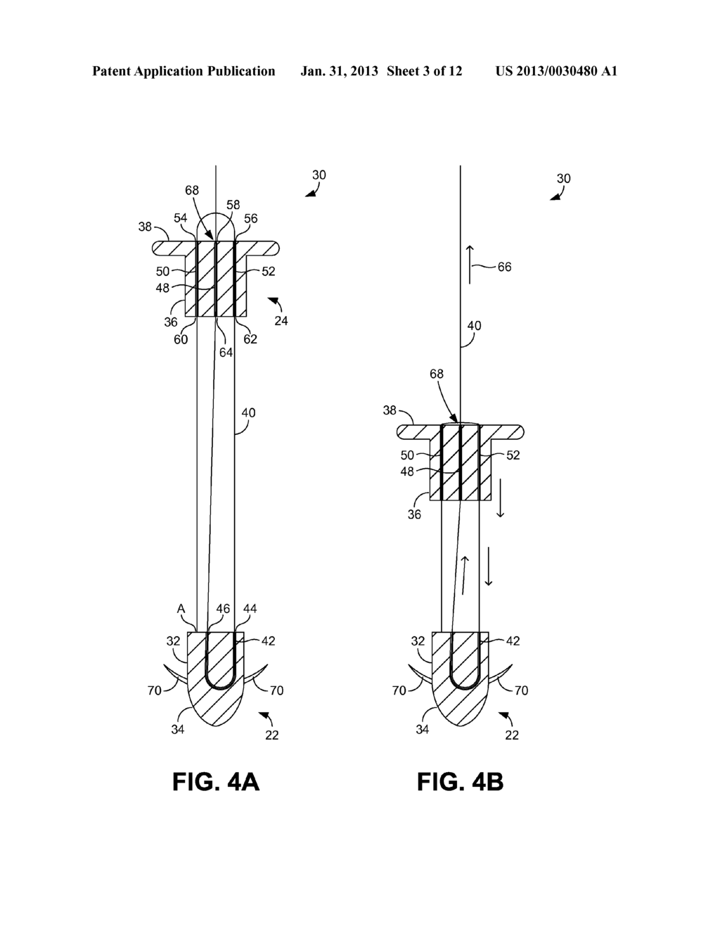 SYSTEMS AND METHODS FOR ANKLE SYNDESMOSIS FIXATION - diagram, schematic, and image 04