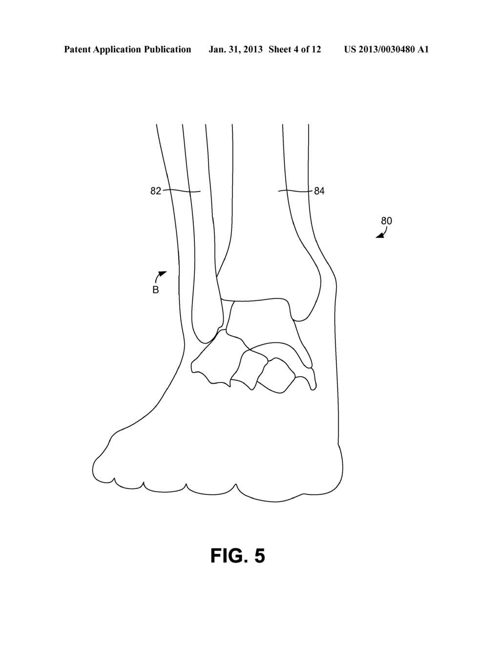 SYSTEMS AND METHODS FOR ANKLE SYNDESMOSIS FIXATION - diagram, schematic, and image 05