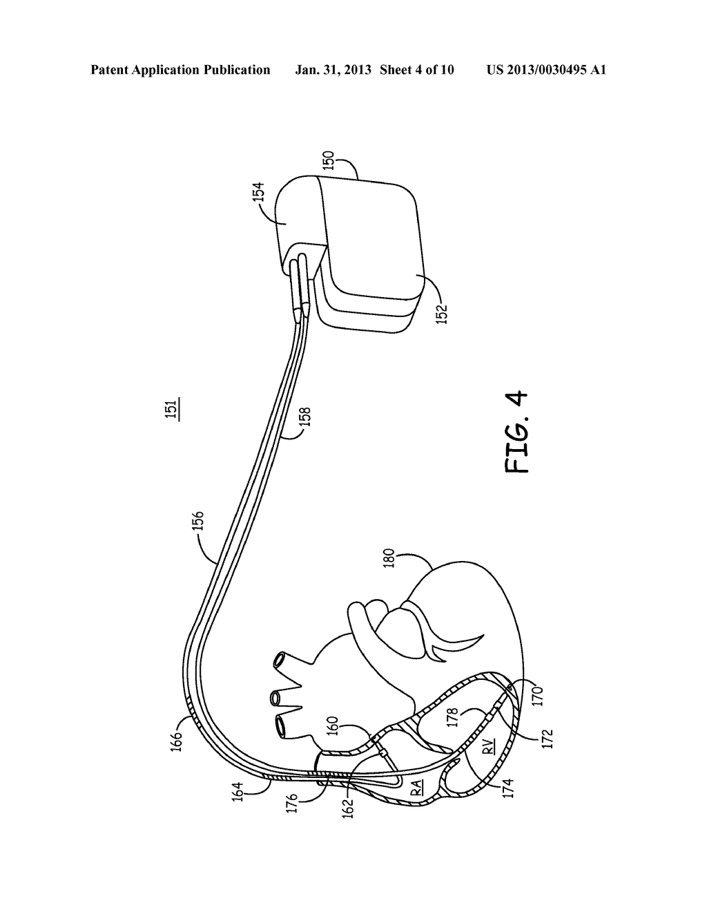 METHOD AND APPARATUS TO DETECT SUBCEREBRAL ISCHEMIA - diagram, schematic, and image 05