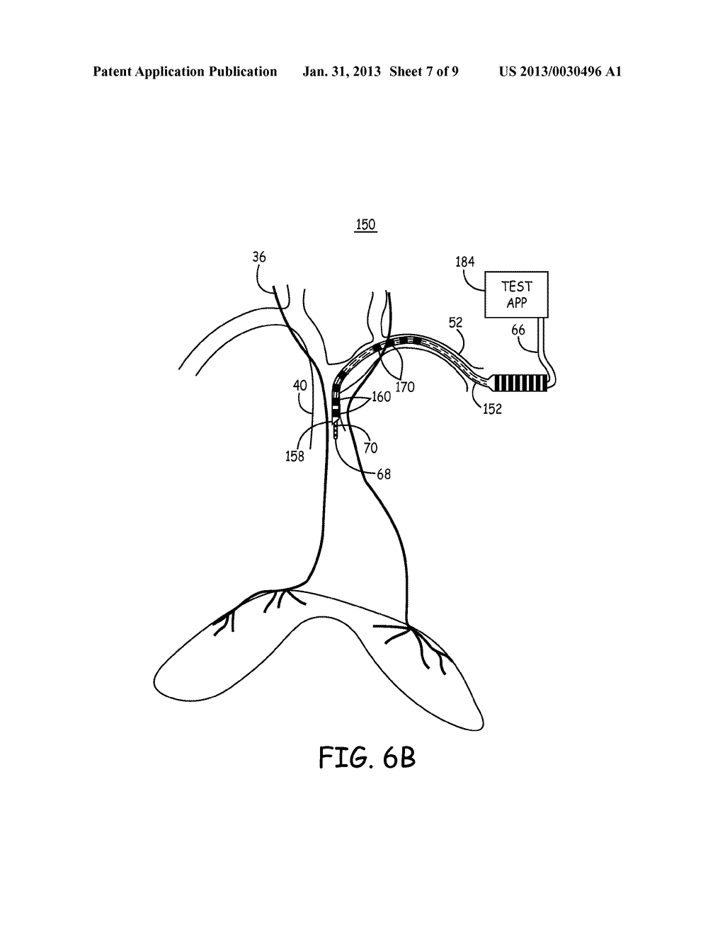 TRANSVENOUS METHOD TO INDUCE RESPIRATION - diagram, schematic, and image 08