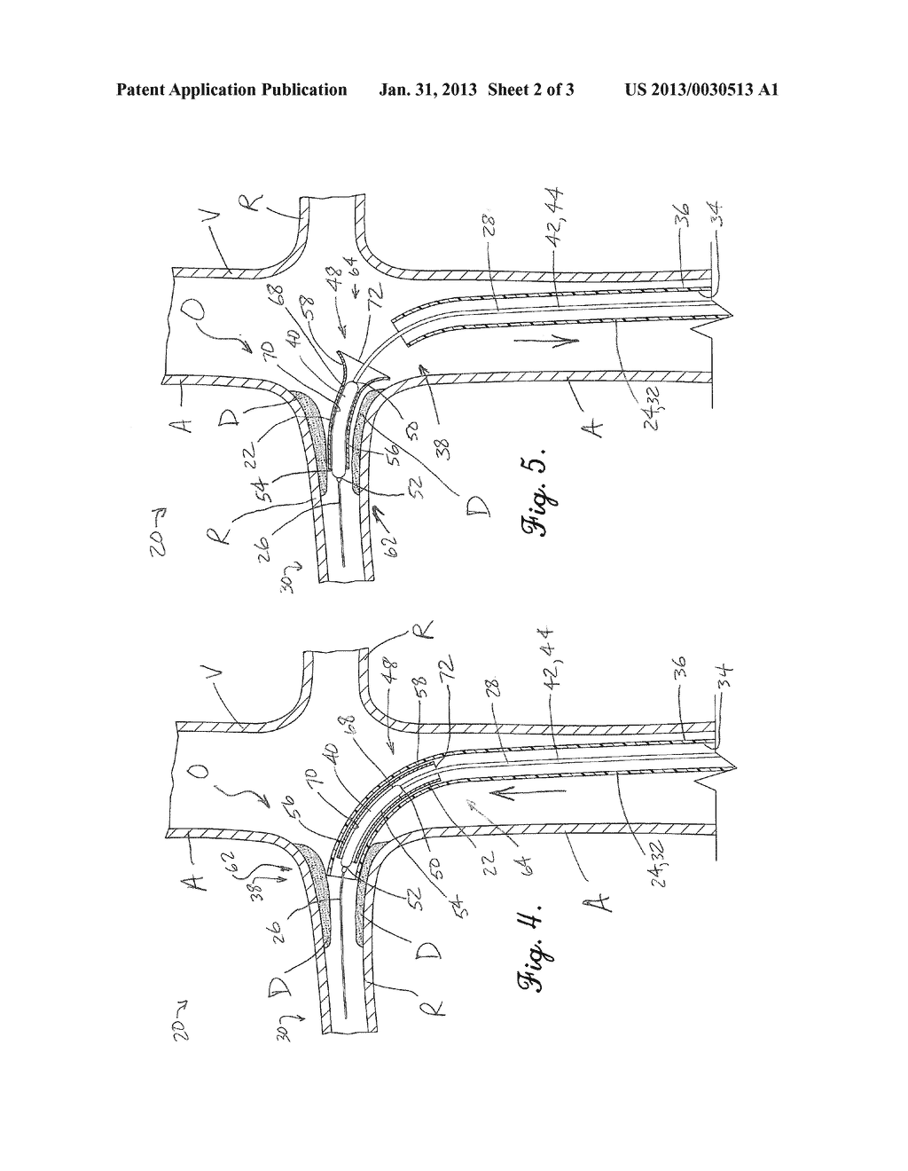 OSTIAL STENT - diagram, schematic, and image 03