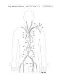 Introducer With Extension diagram and image