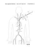 Introducer With Extension diagram and image