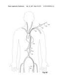 Introducer With Extension diagram and image