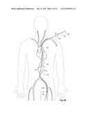 Introducer With Extension diagram and image