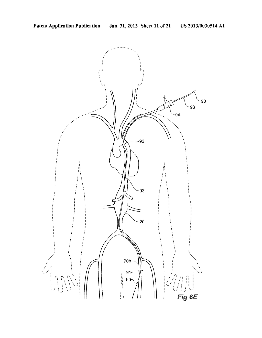 Introducer With Extension - diagram, schematic, and image 12