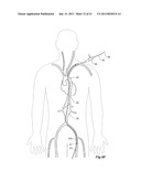 Introducer With Extension diagram and image