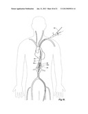 Introducer With Extension diagram and image