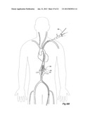 Introducer With Extension diagram and image