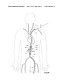 Introducer With Extension diagram and image