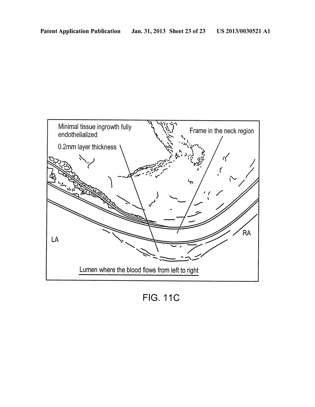 DEVICES FOR REDUCING LEFT ATRIAL PRESSURE HAVING BIODEGRADABLE     CONSTRICTION, AND METHODS OF MAKING AND USING SAME - diagram, schematic, and image 24