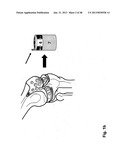 Implantation of Cartilage diagram and image