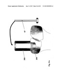 Implantation of Cartilage diagram and image