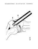 Implantation of Cartilage diagram and image