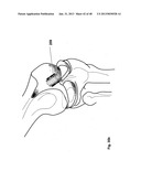 Implantation of Cartilage diagram and image