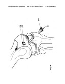 Implantation of Cartilage diagram and image