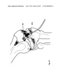 Implantation of Cartilage diagram and image
