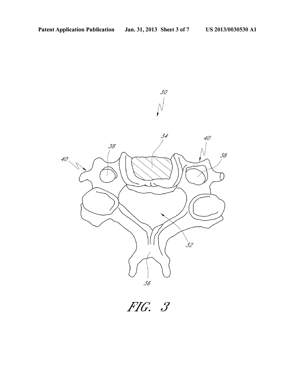 APPARATUS FOR PROMOTING MOVEMENT OF NUTRIENTS TO INTERVERTEBRAL SPACE AND     METHOD OF USE - diagram, schematic, and image 04