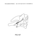 VERTEBRAL JOINT IMPLANTS AND DELIVERY TOOLS diagram and image