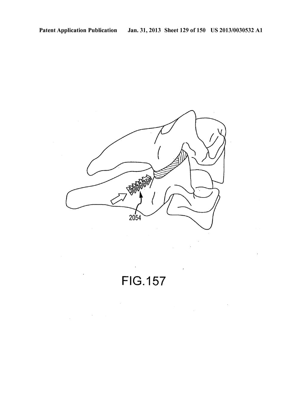 VERTEBRAL JOINT IMPLANTS AND DELIVERY TOOLS - diagram, schematic, and image 130