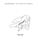 VERTEBRAL JOINT IMPLANTS AND DELIVERY TOOLS diagram and image