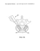 VERTEBRAL JOINT IMPLANTS AND DELIVERY TOOLS diagram and image