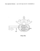 VERTEBRAL JOINT IMPLANTS AND DELIVERY TOOLS diagram and image