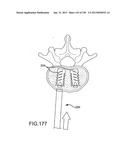 VERTEBRAL JOINT IMPLANTS AND DELIVERY TOOLS diagram and image