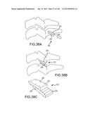 VERTEBRAL JOINT IMPLANTS AND DELIVERY TOOLS diagram and image