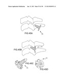 VERTEBRAL JOINT IMPLANTS AND DELIVERY TOOLS diagram and image