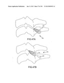 VERTEBRAL JOINT IMPLANTS AND DELIVERY TOOLS diagram and image