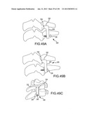 VERTEBRAL JOINT IMPLANTS AND DELIVERY TOOLS diagram and image