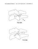 VERTEBRAL JOINT IMPLANTS AND DELIVERY TOOLS diagram and image