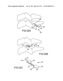 VERTEBRAL JOINT IMPLANTS AND DELIVERY TOOLS diagram and image