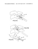 VERTEBRAL JOINT IMPLANTS AND DELIVERY TOOLS diagram and image