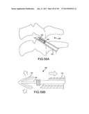 VERTEBRAL JOINT IMPLANTS AND DELIVERY TOOLS diagram and image