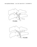 VERTEBRAL JOINT IMPLANTS AND DELIVERY TOOLS diagram and image