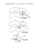 VERTEBRAL JOINT IMPLANTS AND DELIVERY TOOLS diagram and image