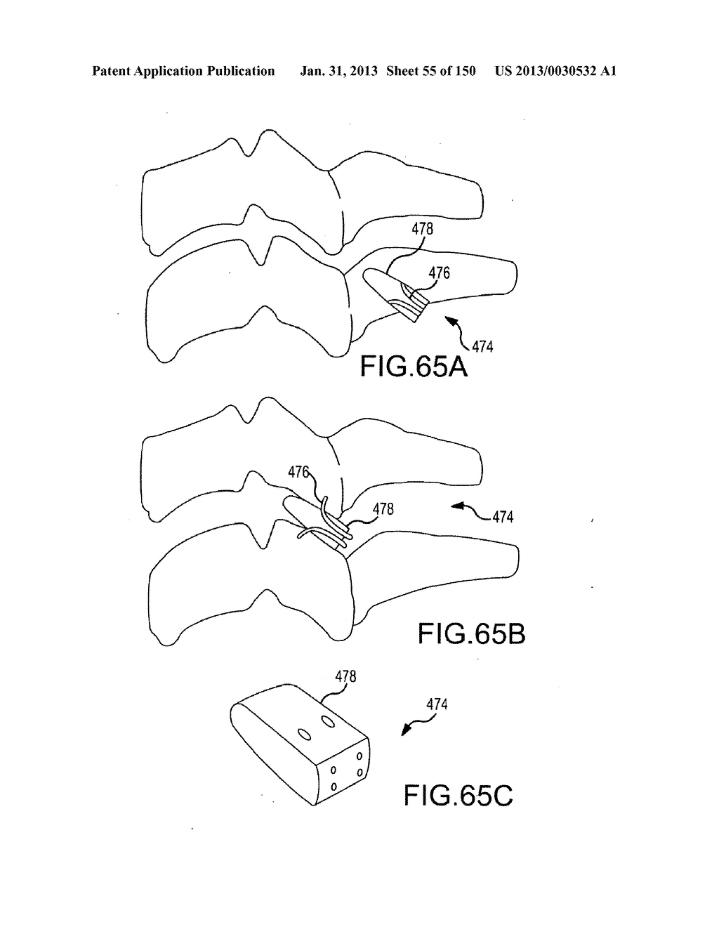 VERTEBRAL JOINT IMPLANTS AND DELIVERY TOOLS - diagram, schematic, and image 56