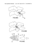 VERTEBRAL JOINT IMPLANTS AND DELIVERY TOOLS diagram and image