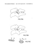 VERTEBRAL JOINT IMPLANTS AND DELIVERY TOOLS diagram and image