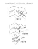 VERTEBRAL JOINT IMPLANTS AND DELIVERY TOOLS diagram and image